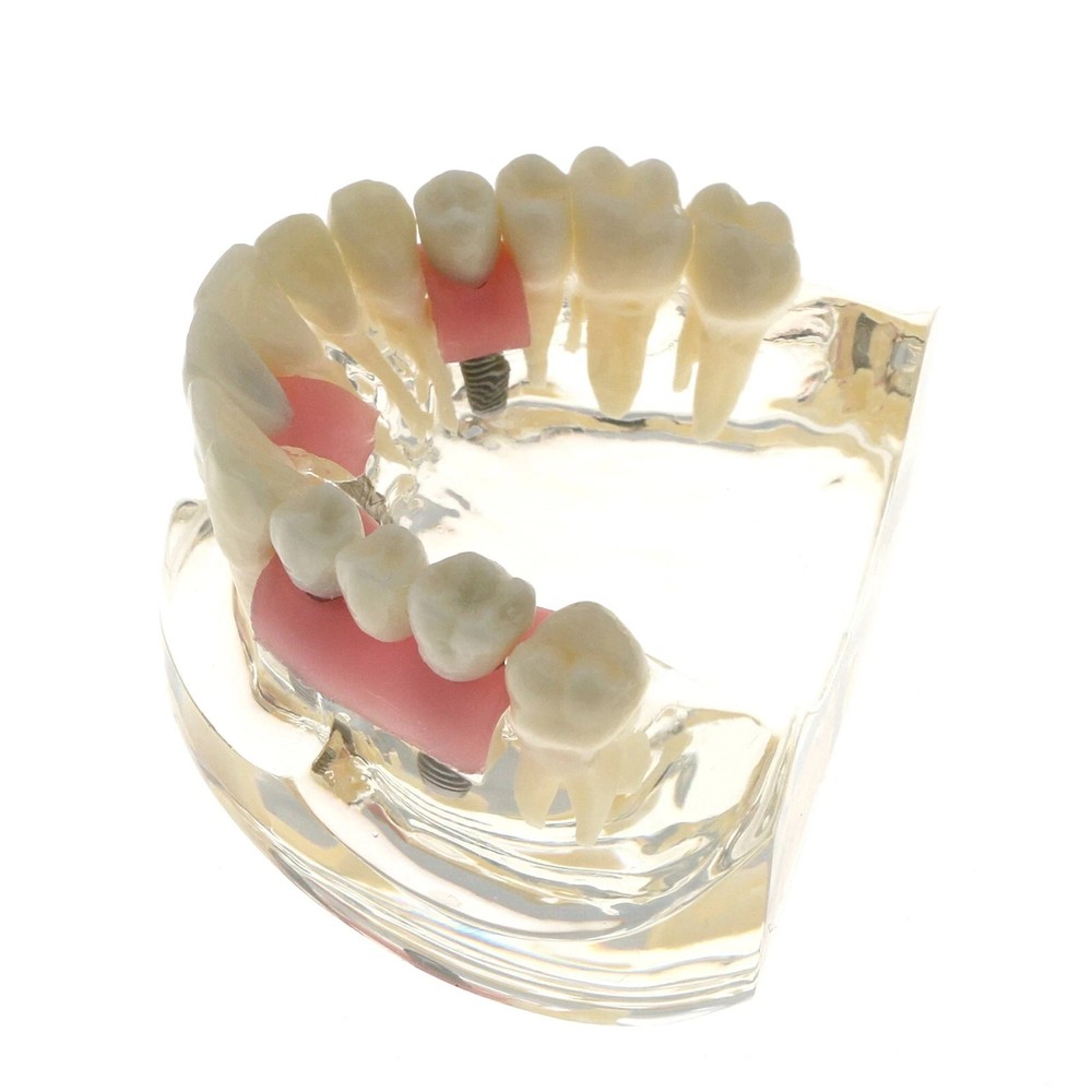 1Pcs Orthodontic Dental Implant Pathological Perio Practice Typodont Model M2005