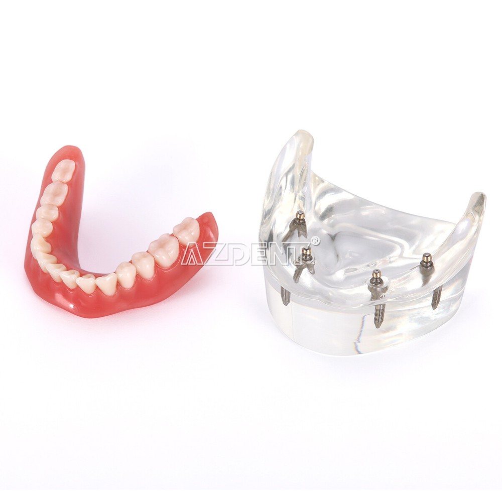Dental Implant Teach Study Model Demo Overdenture Typodont 4Implants Upper Lower