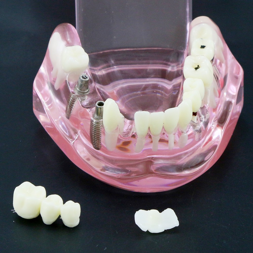 Dental Model Bridge Restoration Pathology Study Demo Teaching Model M2001
