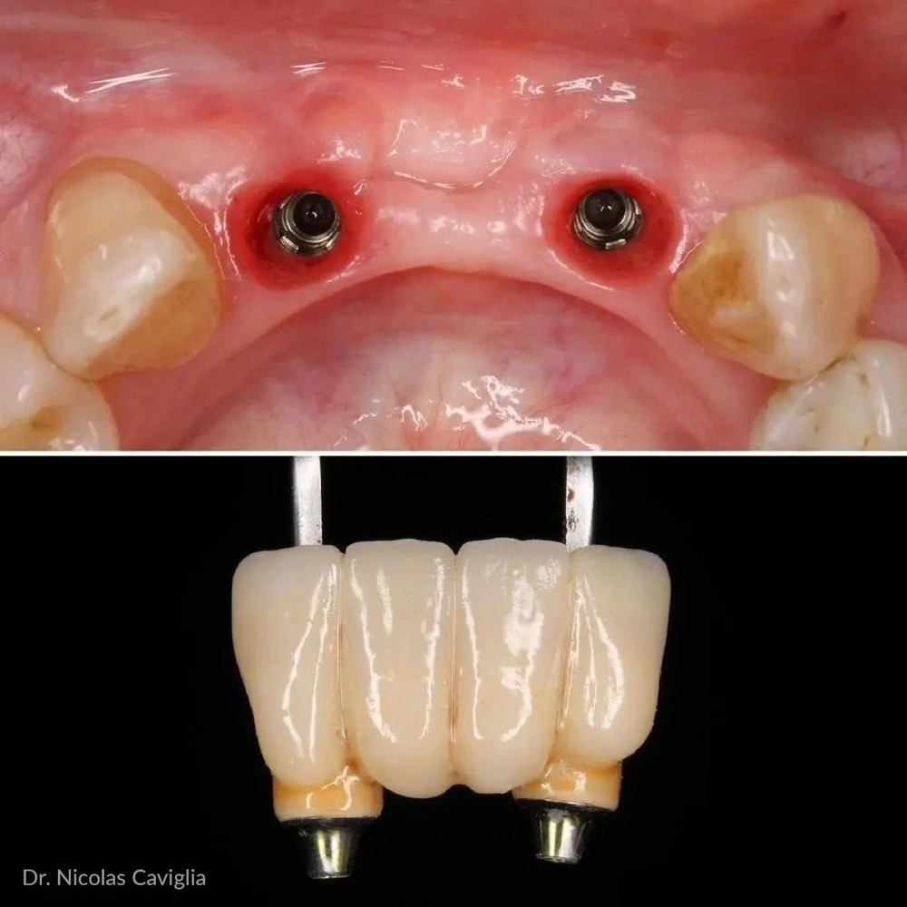 CEREC® Blocks Lithium Disilicate x5