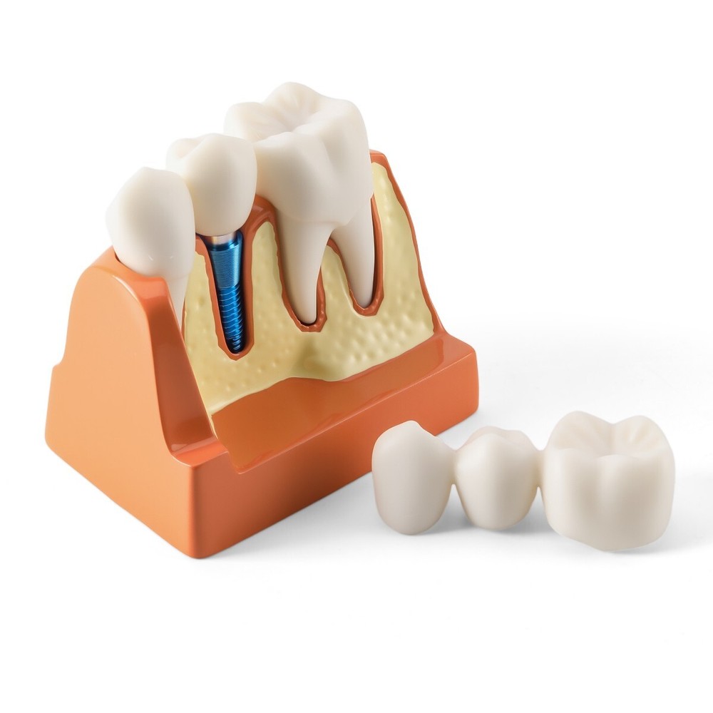 Dental Implant 4 Times Analysis Crown Bridge Demonstration Removable Teeth Model