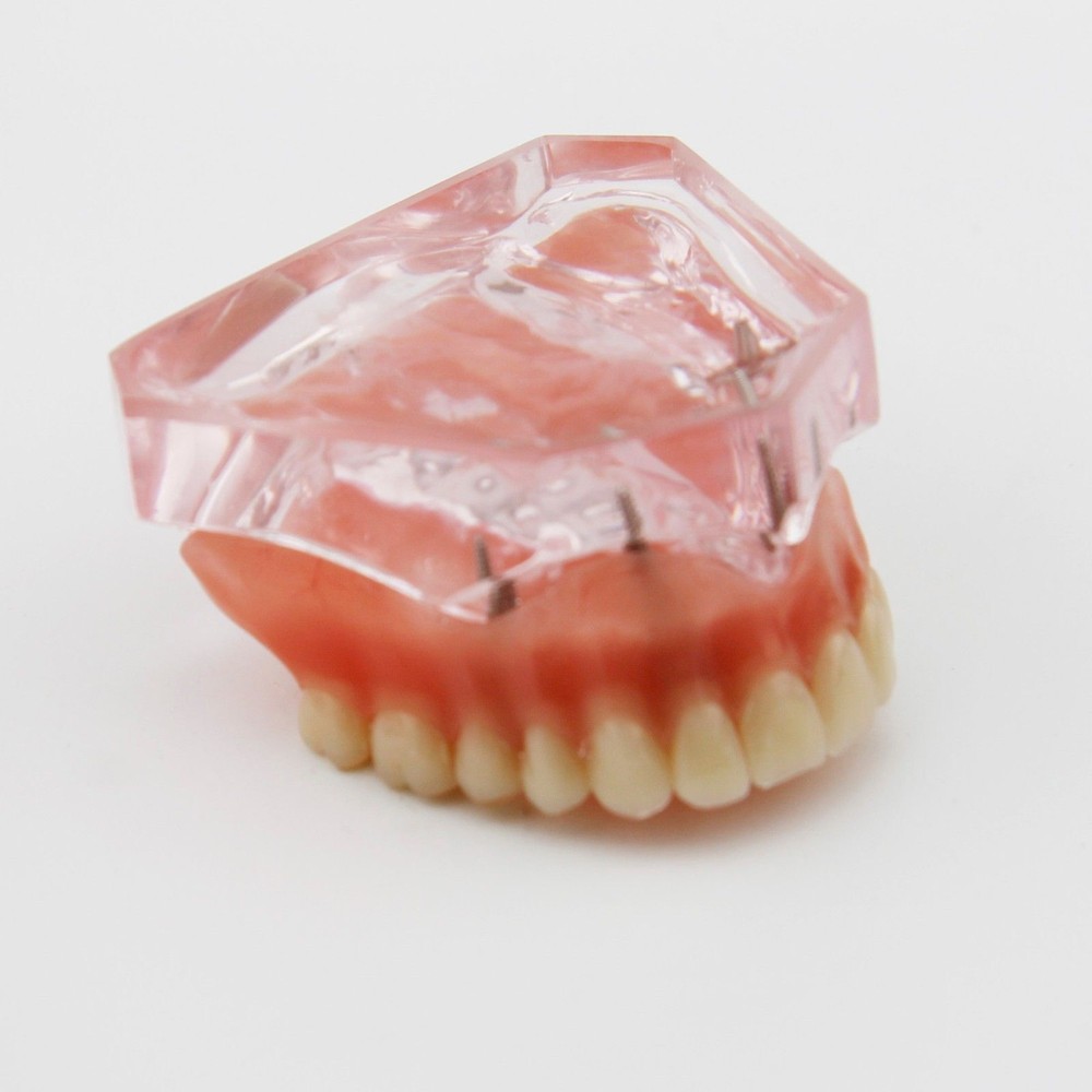 Dental Implant Teeth Model Demo Overdenture Restoration Teaching Study 4 Models