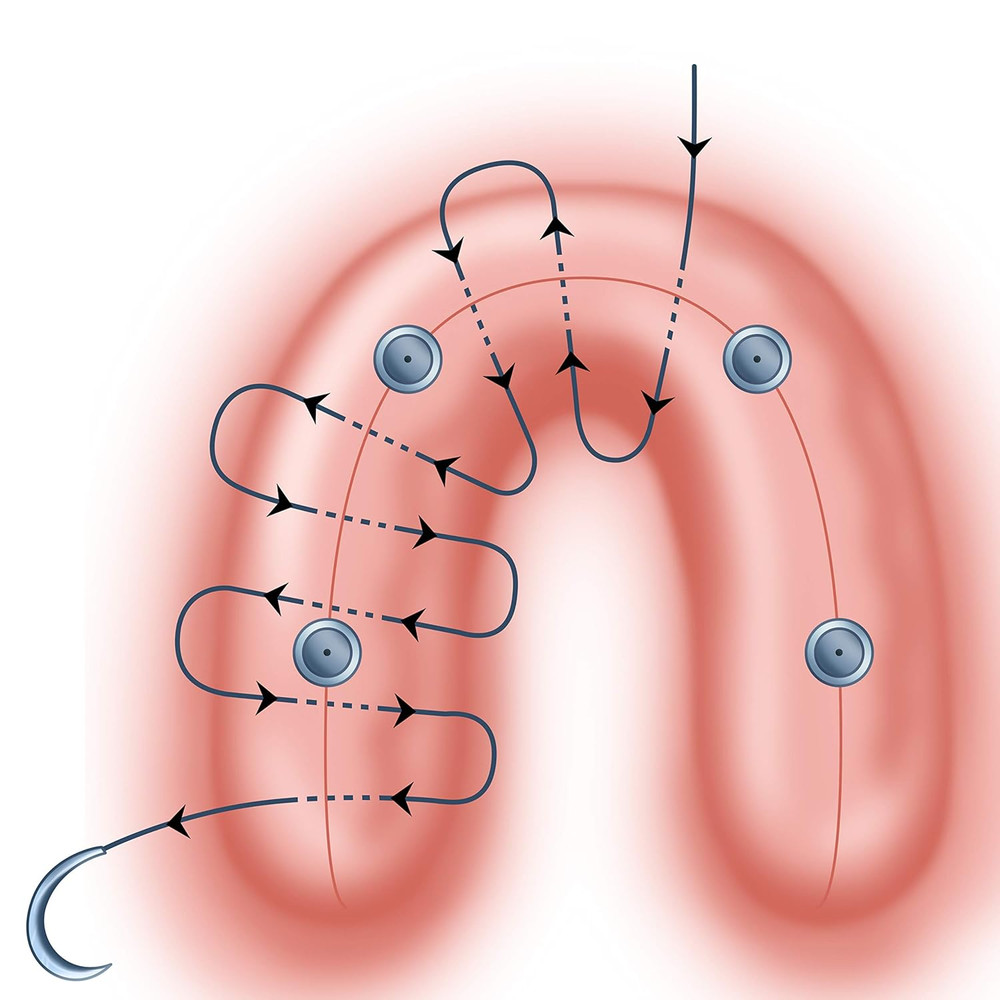 Pterygoid Implants: the Art and Science