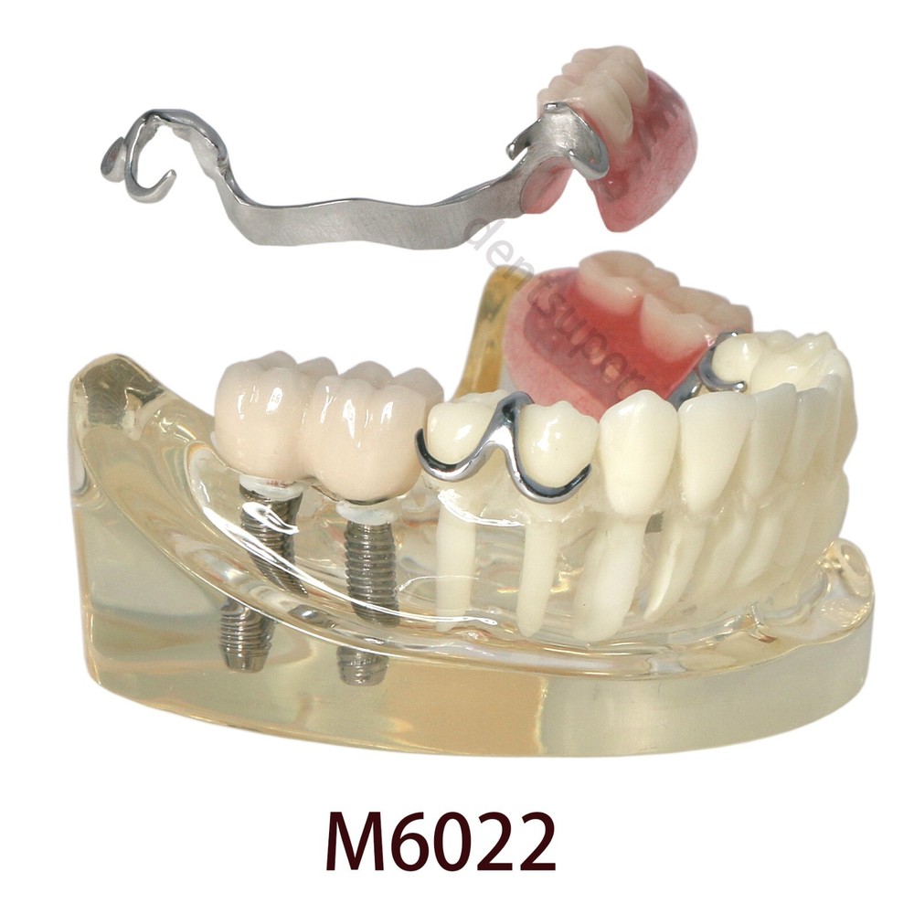 Typodont Restoration Dental Teeth Model With Partial Denture Demo 2 Implants