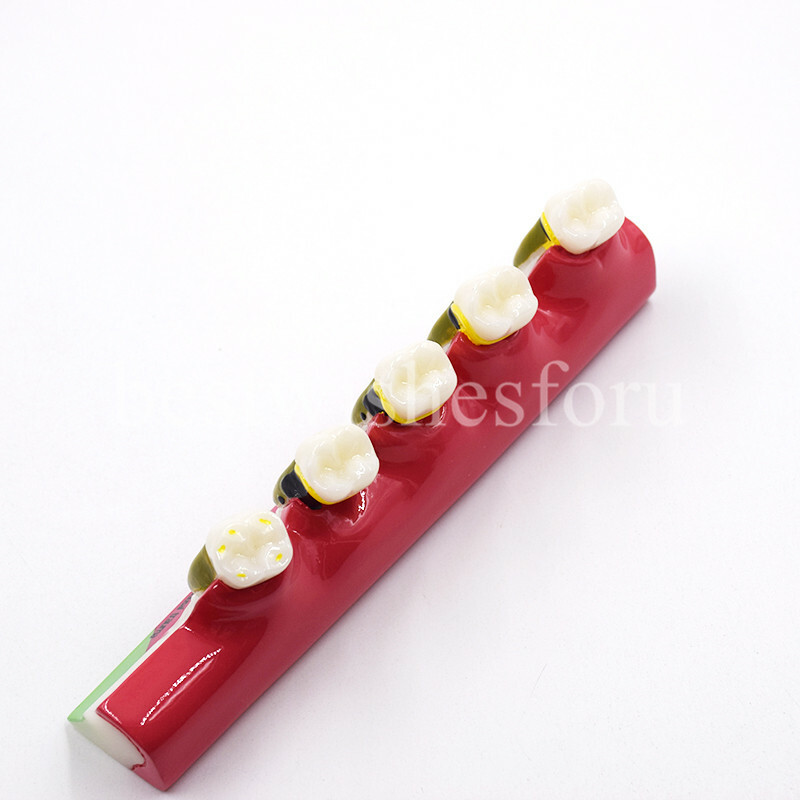 Dental Periodontal Disease Assort Developing Demonstration Teeth Study Model
