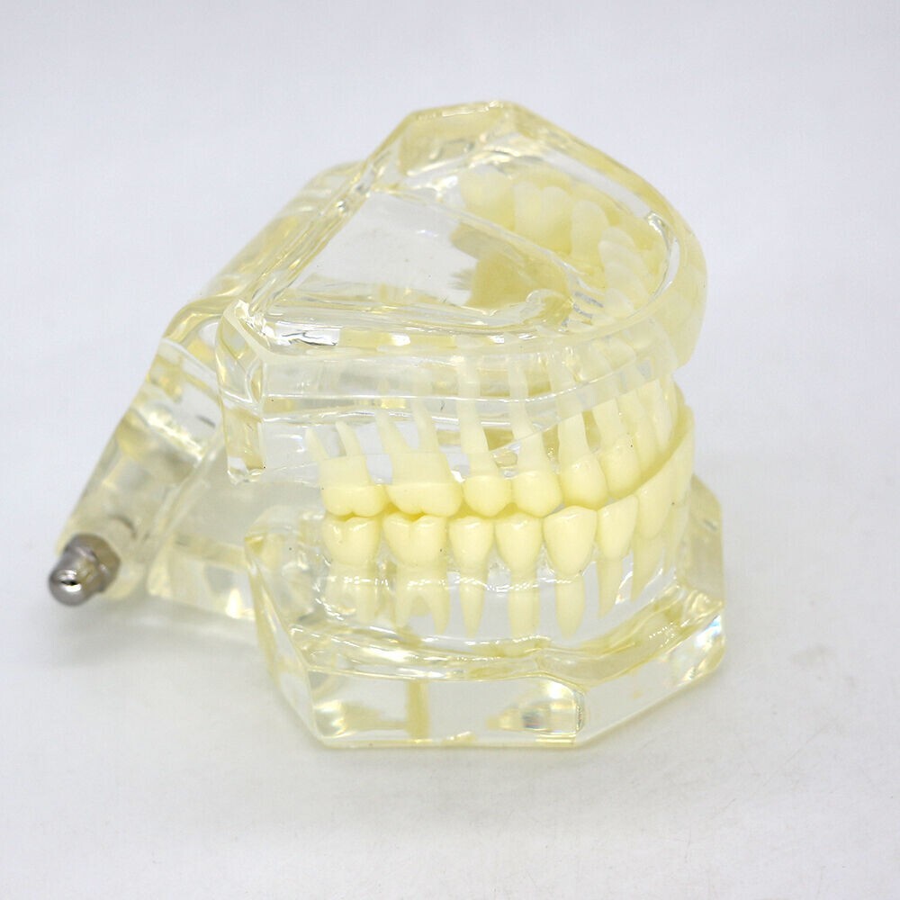 1×Yellow Transparent Plastic Study Teeth Model Demonstrate Comprehensive Repair