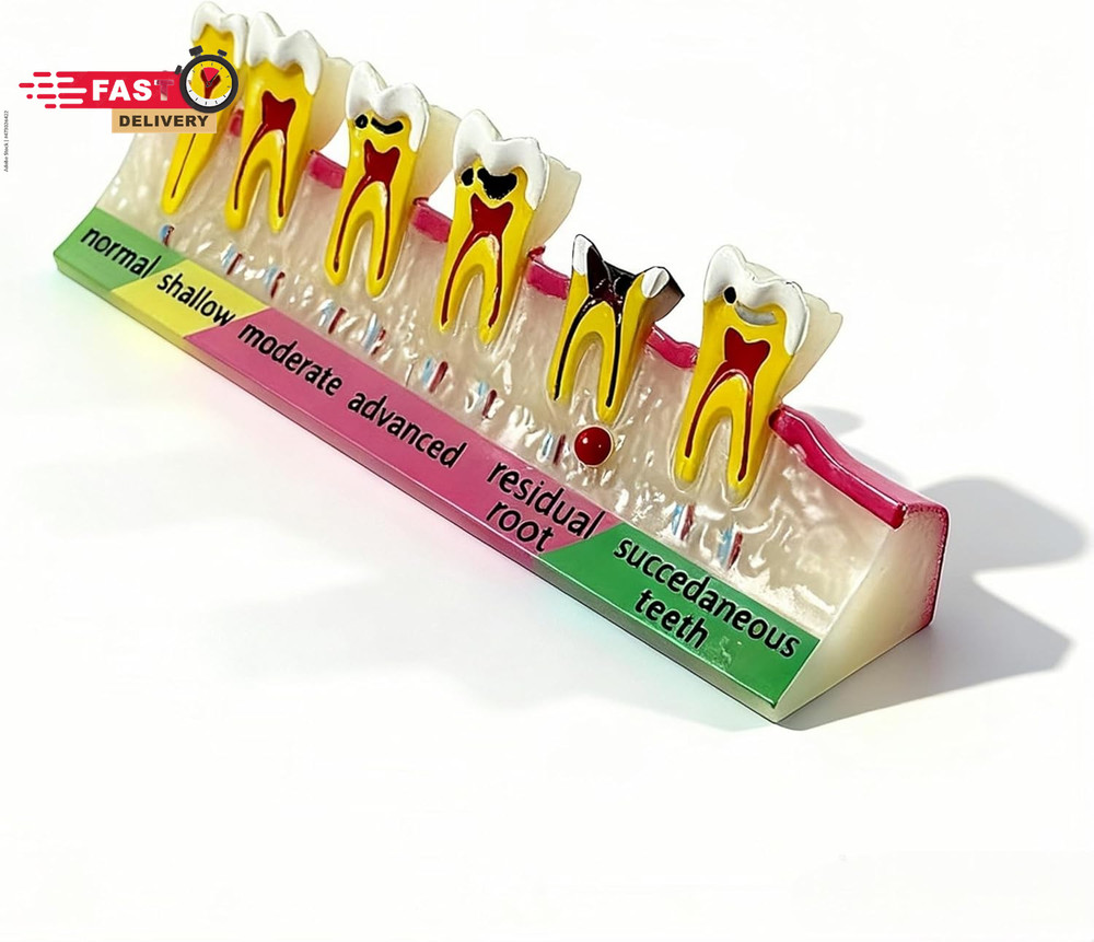 6-Stage Dental Caries Development Model - Anatomical Teeth Decay Demonstration w