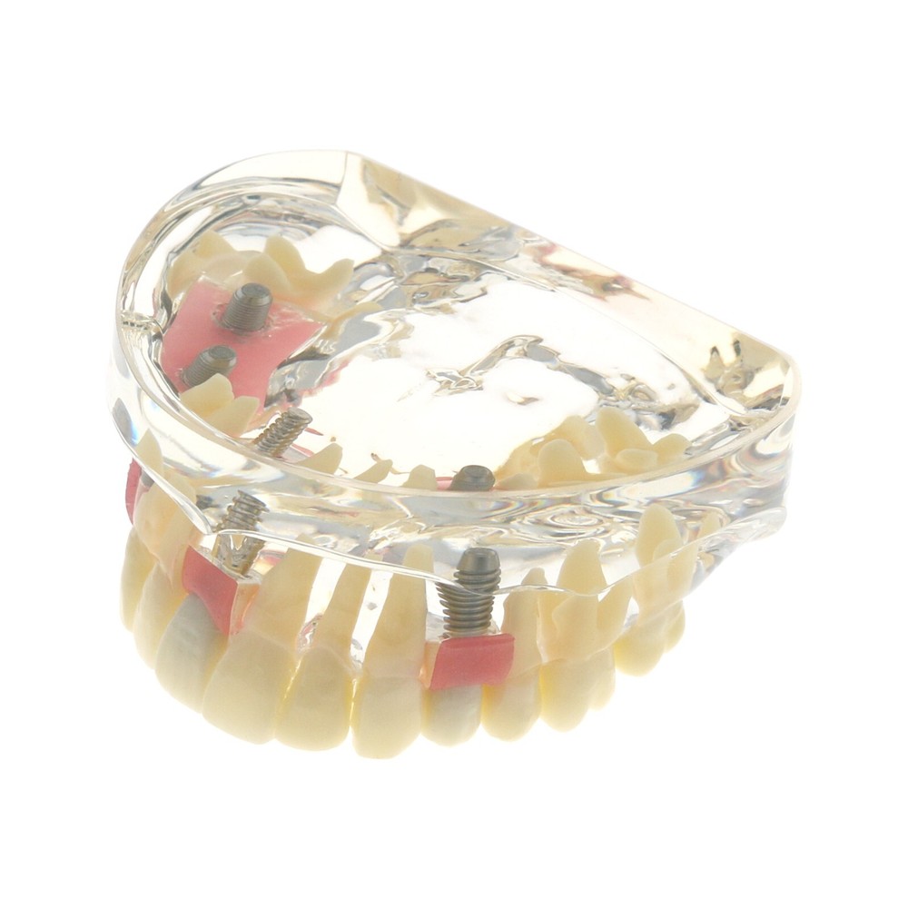 Detal Typondont Restoration Implant Teeth Model 2 3 4 Implants For Studying
