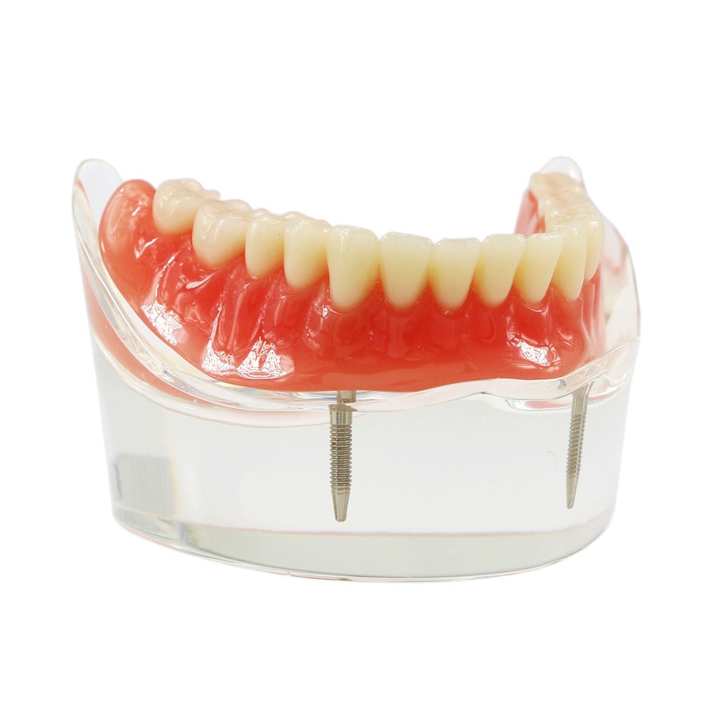 Implant Restoration Teeth Model Mandibular Overdenture with 2 Implants Dental