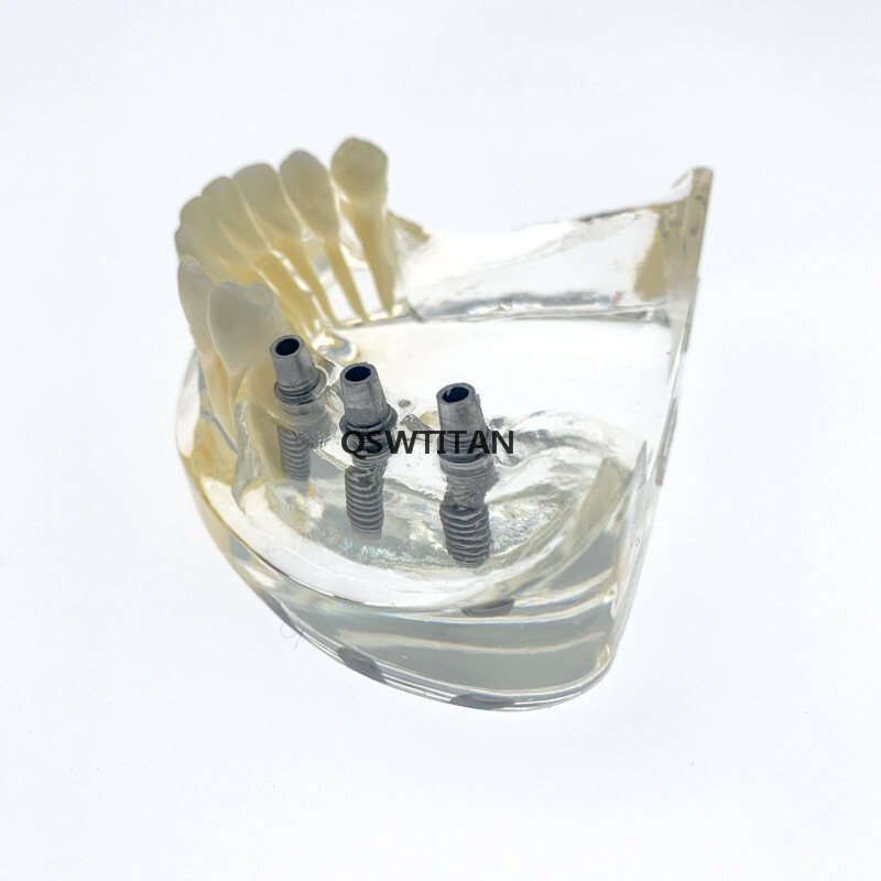 Dental Implant Restoration Model Removable Bridge Denture Teaching teeth model