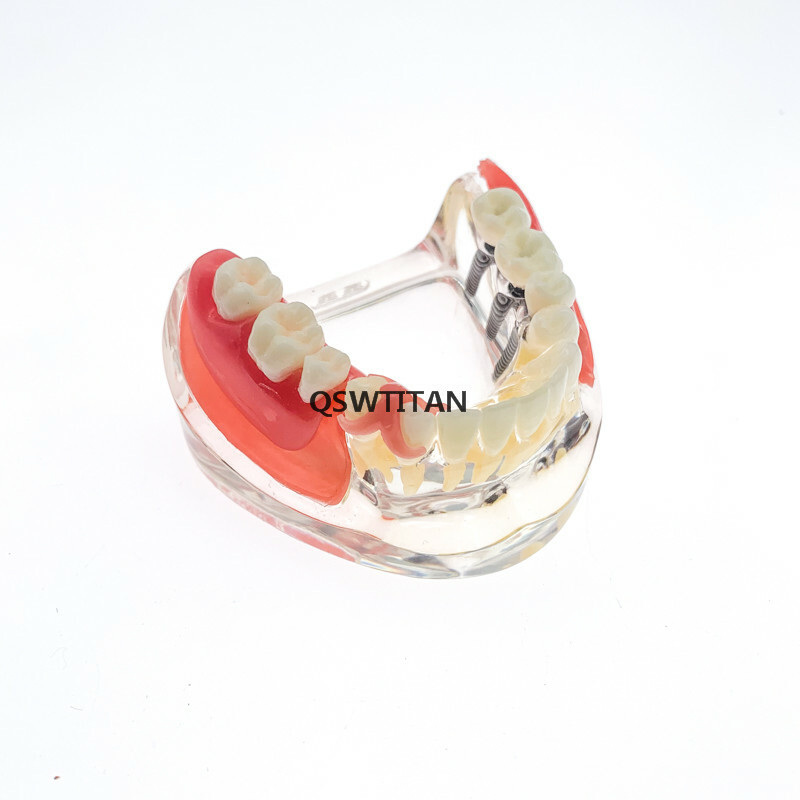 Dental Implant Restoration Teeth Model Removable Bridge Denture Teaching model