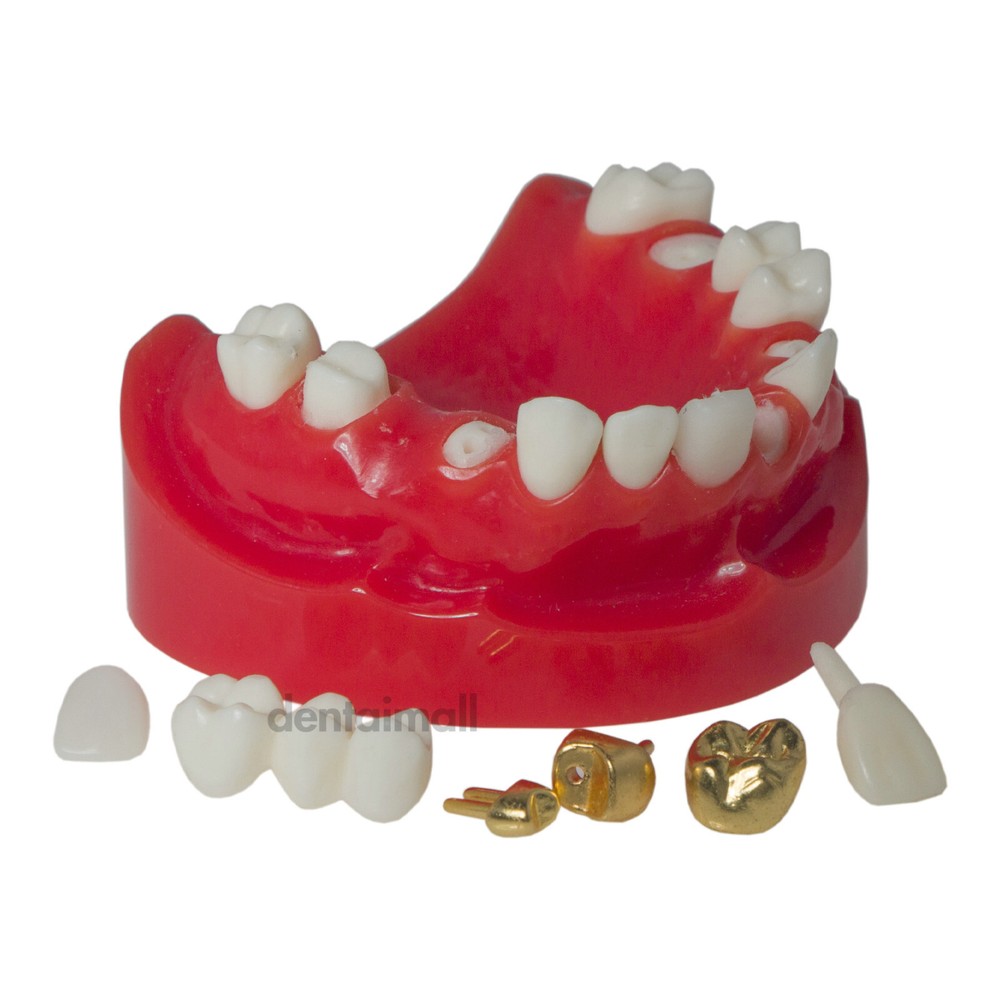 Dental Teeth Crown Restoration Model with Post Core Bridge for Teaching M6004