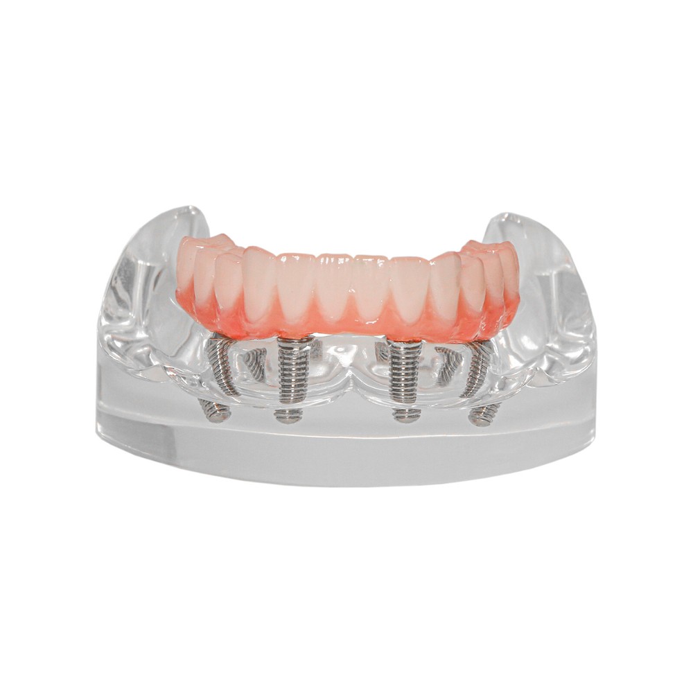 Dental 4 Implants Upper&Lower Demo Implant Teeth Model Restoration Overdenture