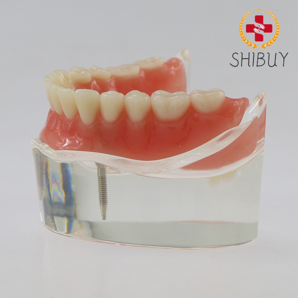 M6002 Dental Overdenture Inferior with 2 Implants Demo Model