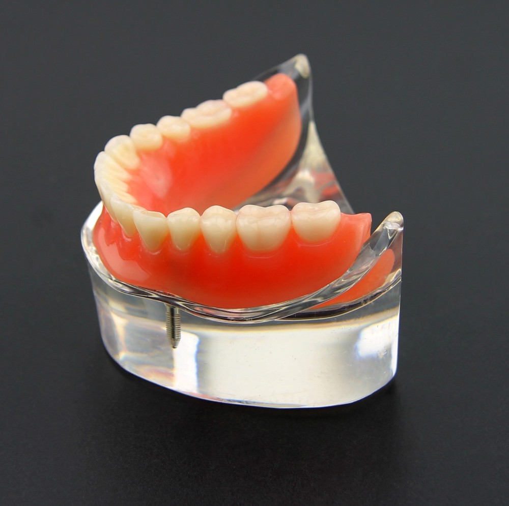 Dental Inferior Overdenture Anatomical Model Teeth Typodont Lower Jaw 2 Implants