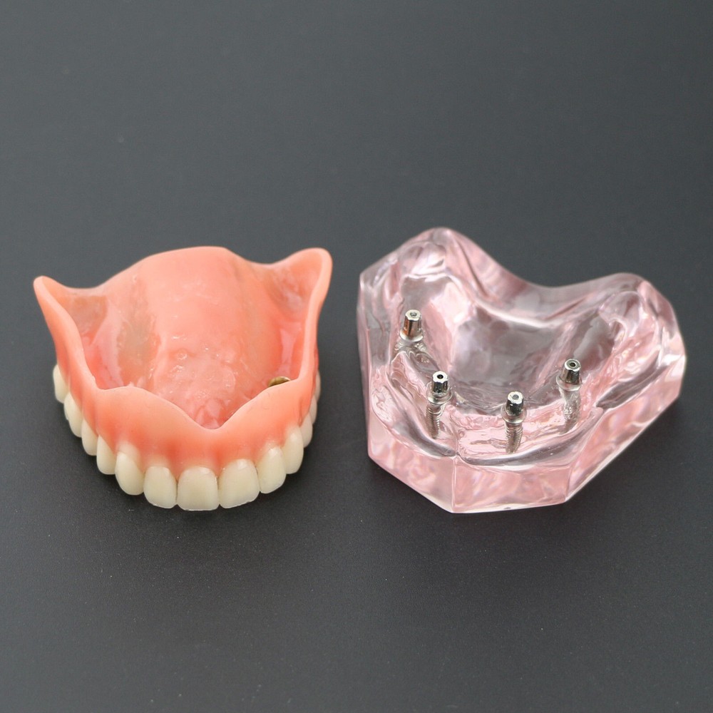 Dental Teeth Model Demo Overdenture Restoration With 4 Implants Upper Maxillary