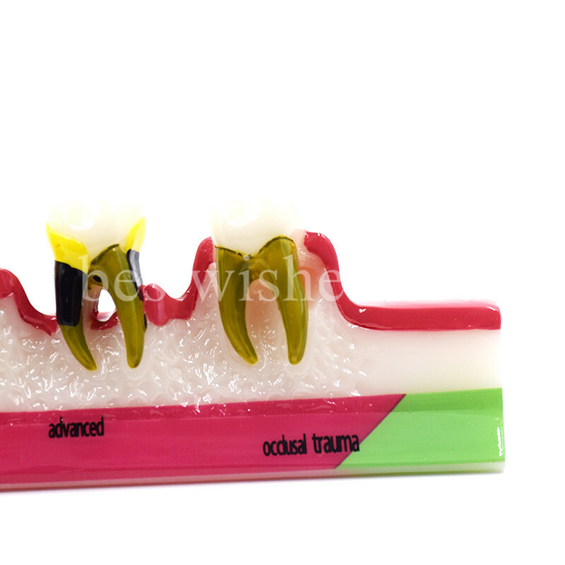 Dental Periodontal Disease Assort Developing Demonstration Teeth Study Model