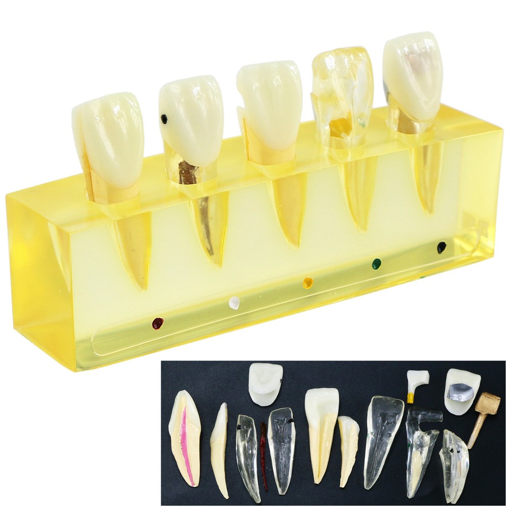 Endodontic Treatment Root Canal Tooth Teach Study Dental Teeth Removable Model