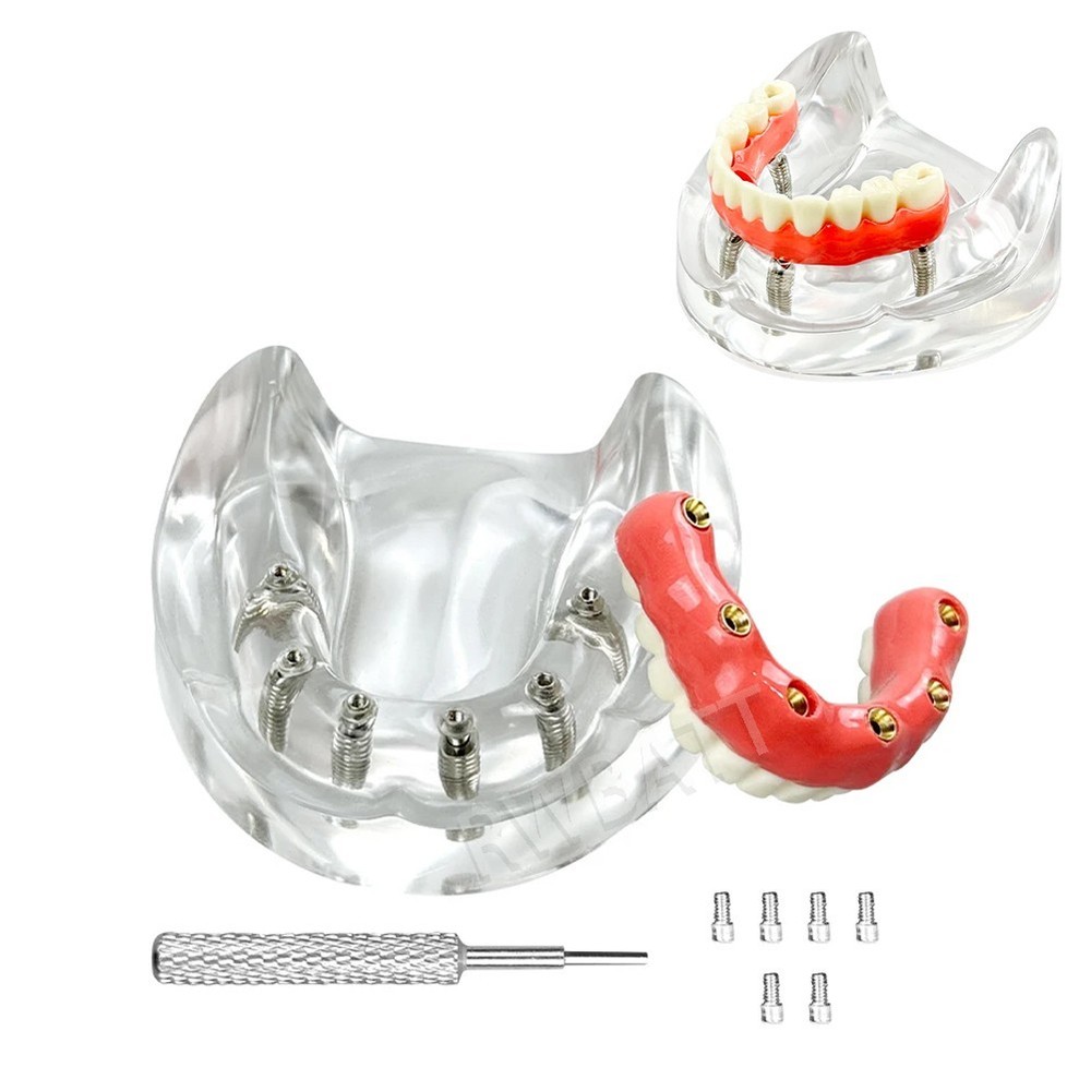 Dental Lower 4/6 Implants Removable Overdenture Restoration Demo Teeth Model