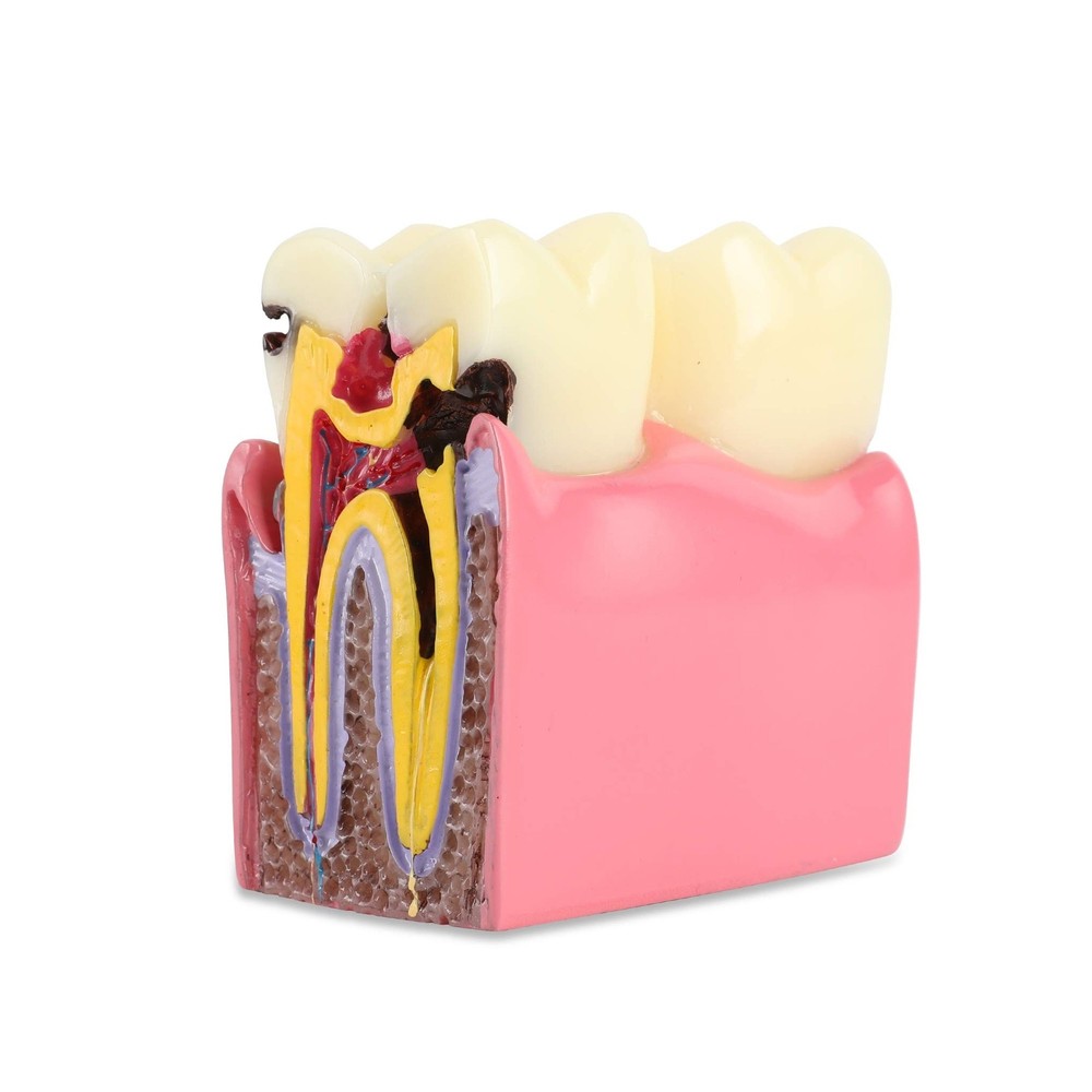 Dental Caries Tooth Model 6 Times Decay Teeth Comparative Study Model, Caries...