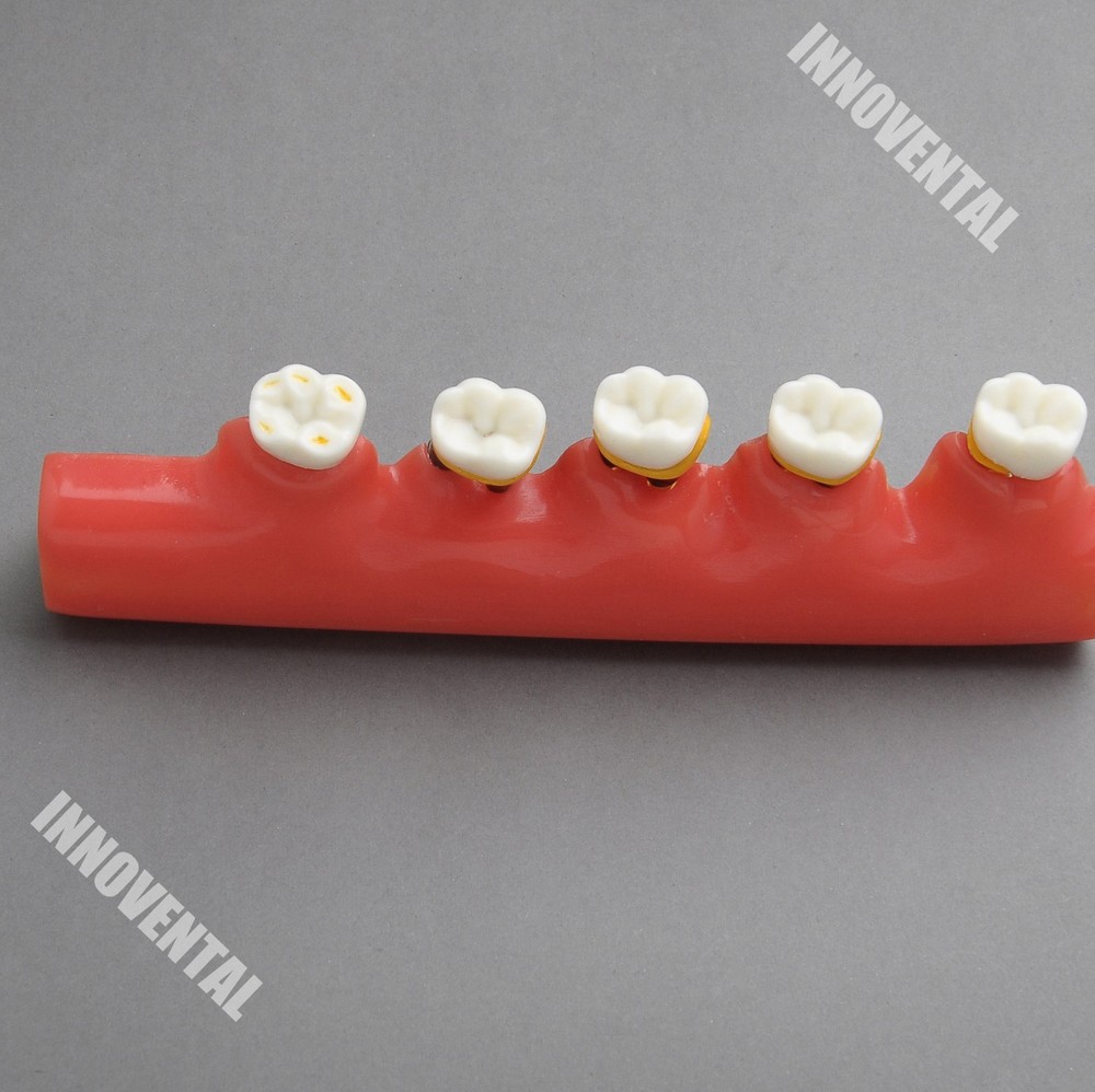Dental Model #4010 01 - 5-Stage Periodontitis Model