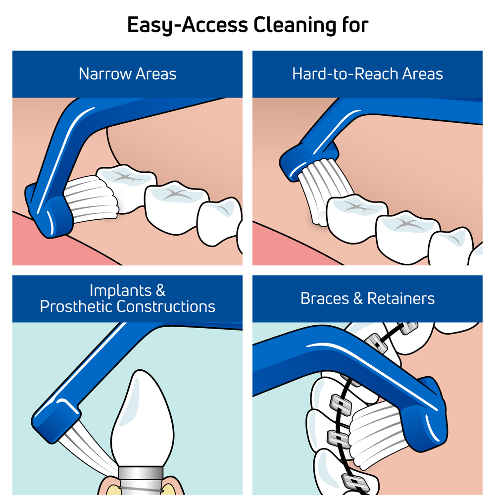TEPE Universal Care Toothbrush – Angled for Braces, Retainers, Implants, 1 Pk