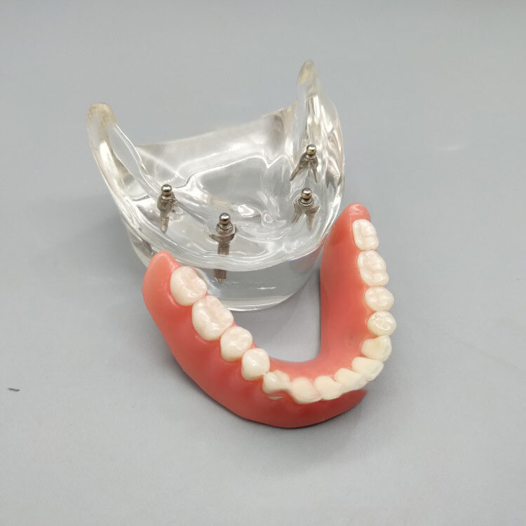 Dental Tooth Model Brushing Training Practice Implant Overdenture Restoration