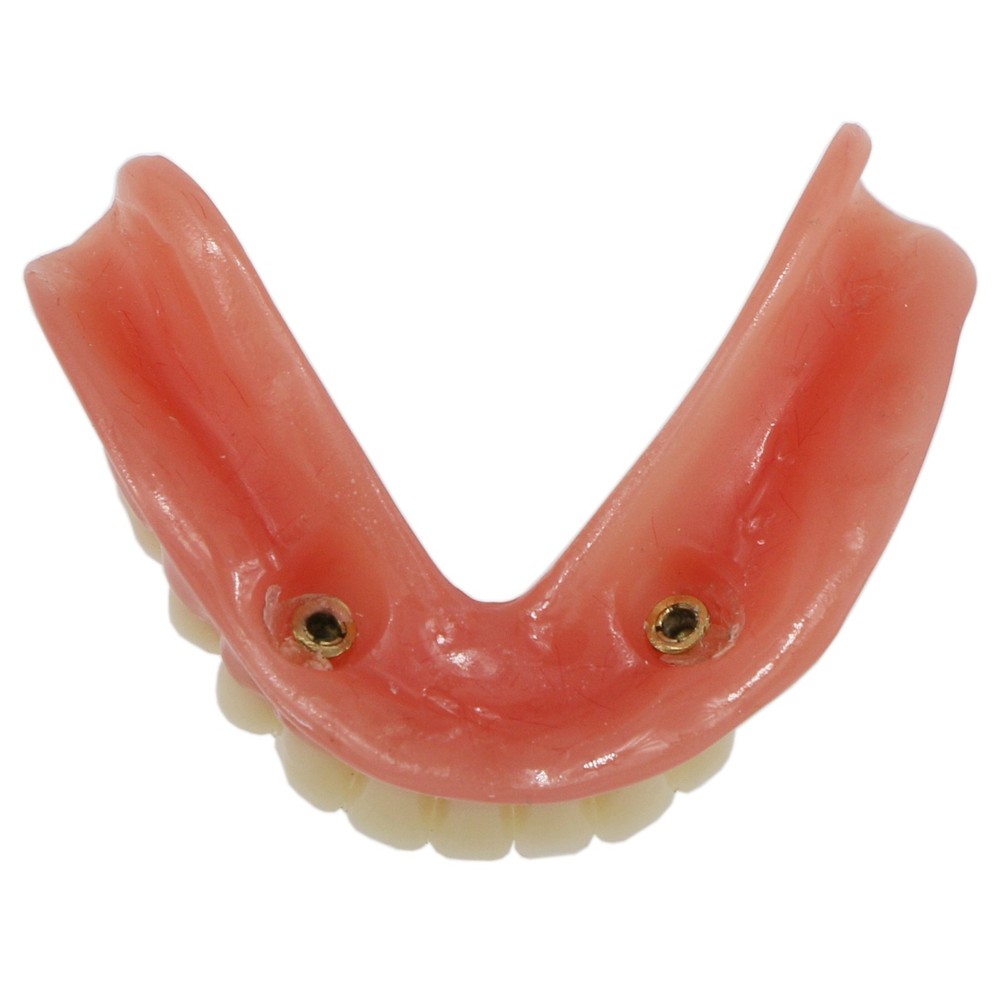 Implant Restoration Teeth Model Mandibular Overdenture with 2 Implants Dental