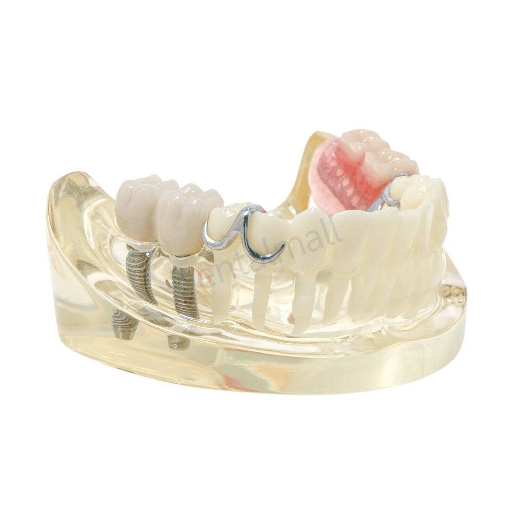 Dental Typodont Restoration Model With 2 Implants Partial Denture Demo