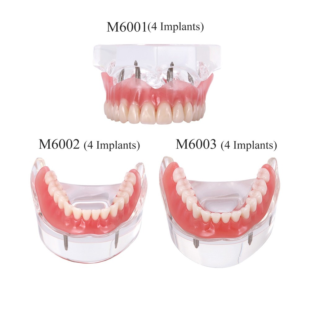 Multi Types Dental Typodont Teeth Model Implant Pathological Perio Practice Demo