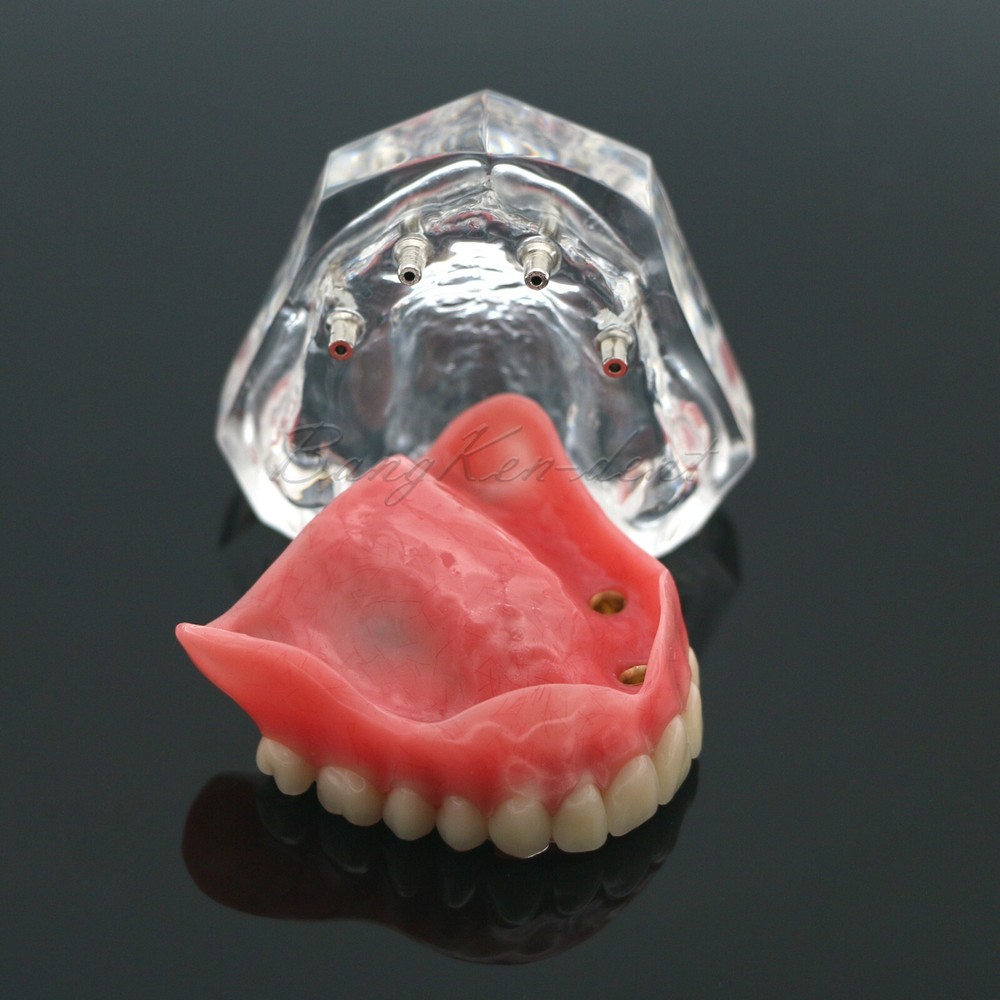 Dental Typodont Implant Overdenture Teeth Model 4 Implants Upper Lower