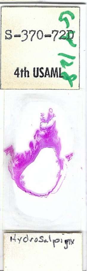 Human Hydrosalpinx Pathology Microscope Slide