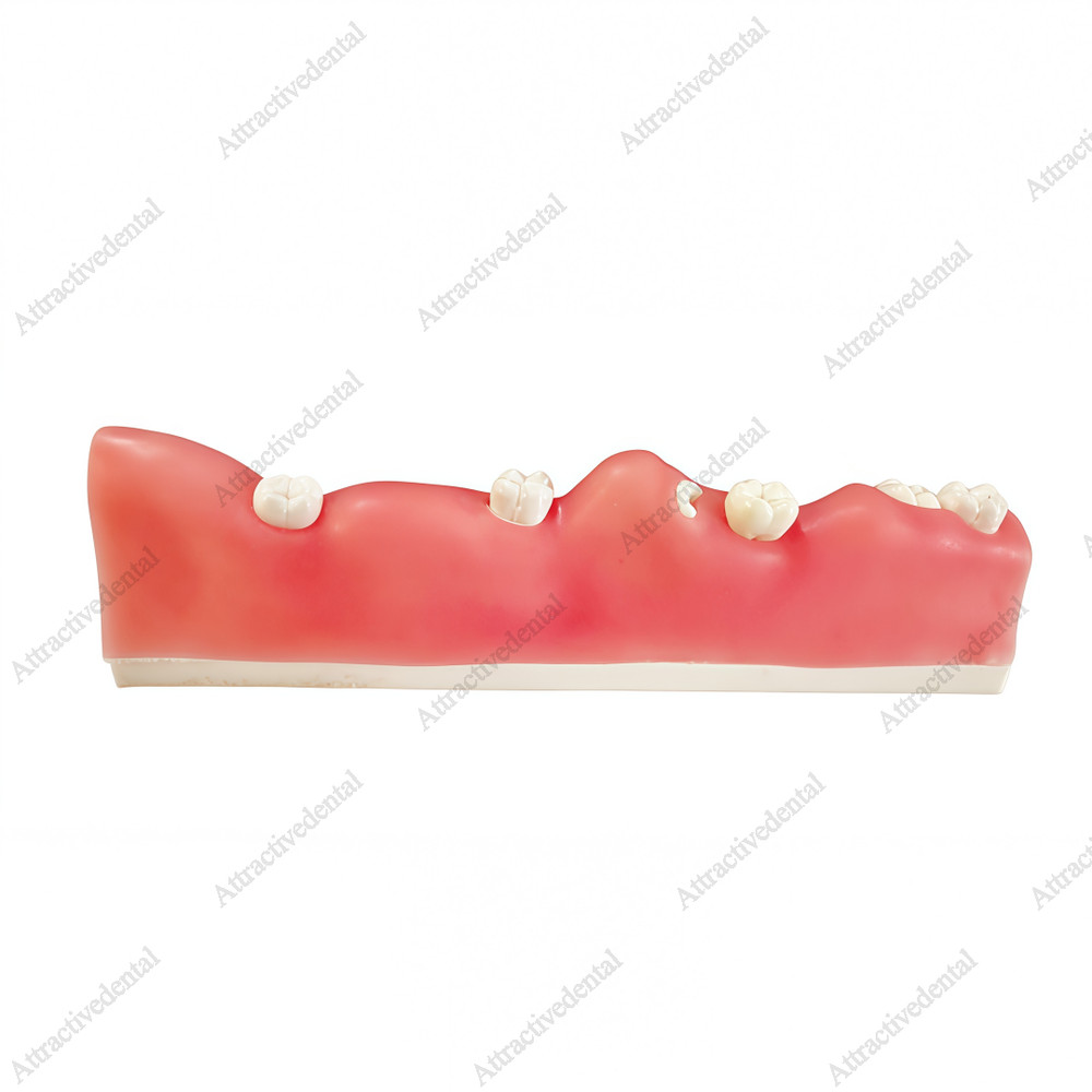 Dental Impacted Tooth Model Wisdom Unerupted Tooth Extraction Practice Training