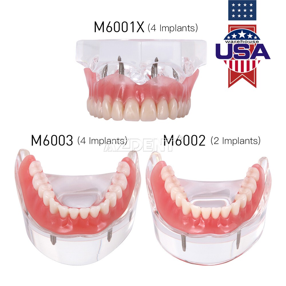 Dental Implant Teeth Model Demo Overdenture Restoration 2 / 4 Implants Upper Low
