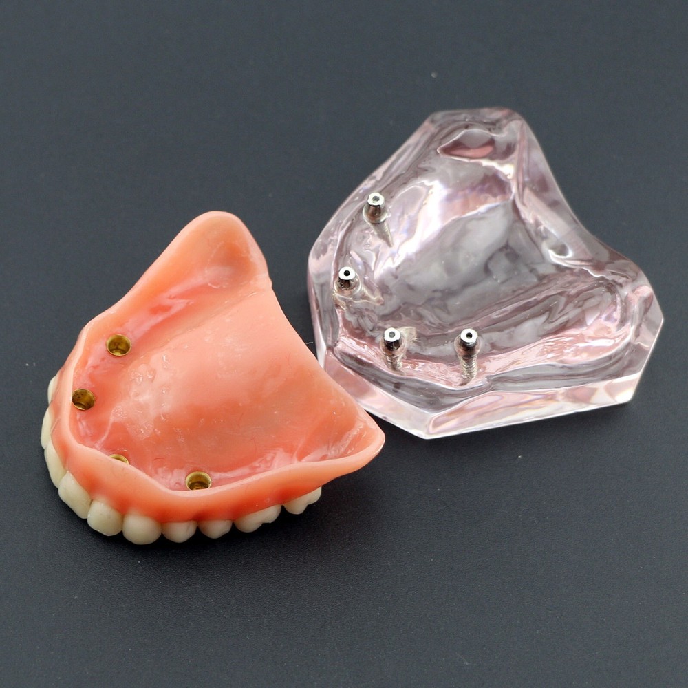 Dental Implant Overdenture Upper Superior Model Precision 4 Maxillary