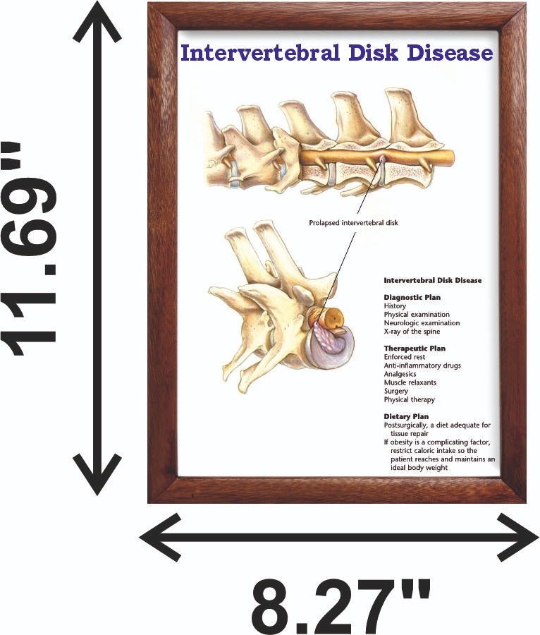 Intervertebral Disk Disease Chart 12x18 inches