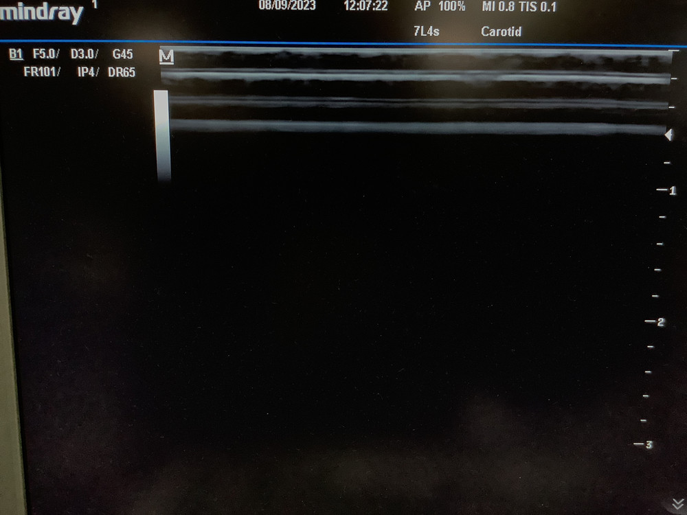 2013 Mindray 7L4s Linear Array Ultrasound Probe