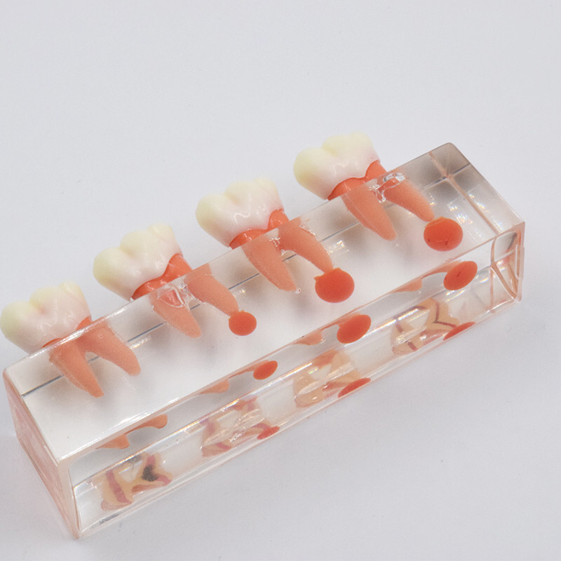 Dental Caries Disease M4018 Study Teaching Model Tooth Correcting Malocclusion