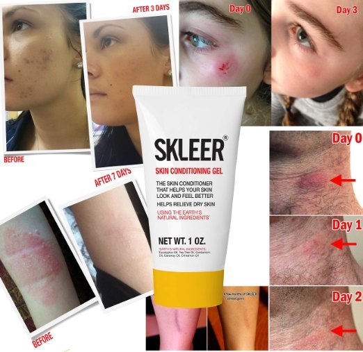 Stretch Marks and Removal of Scars & Pregnancy Stretch Marks