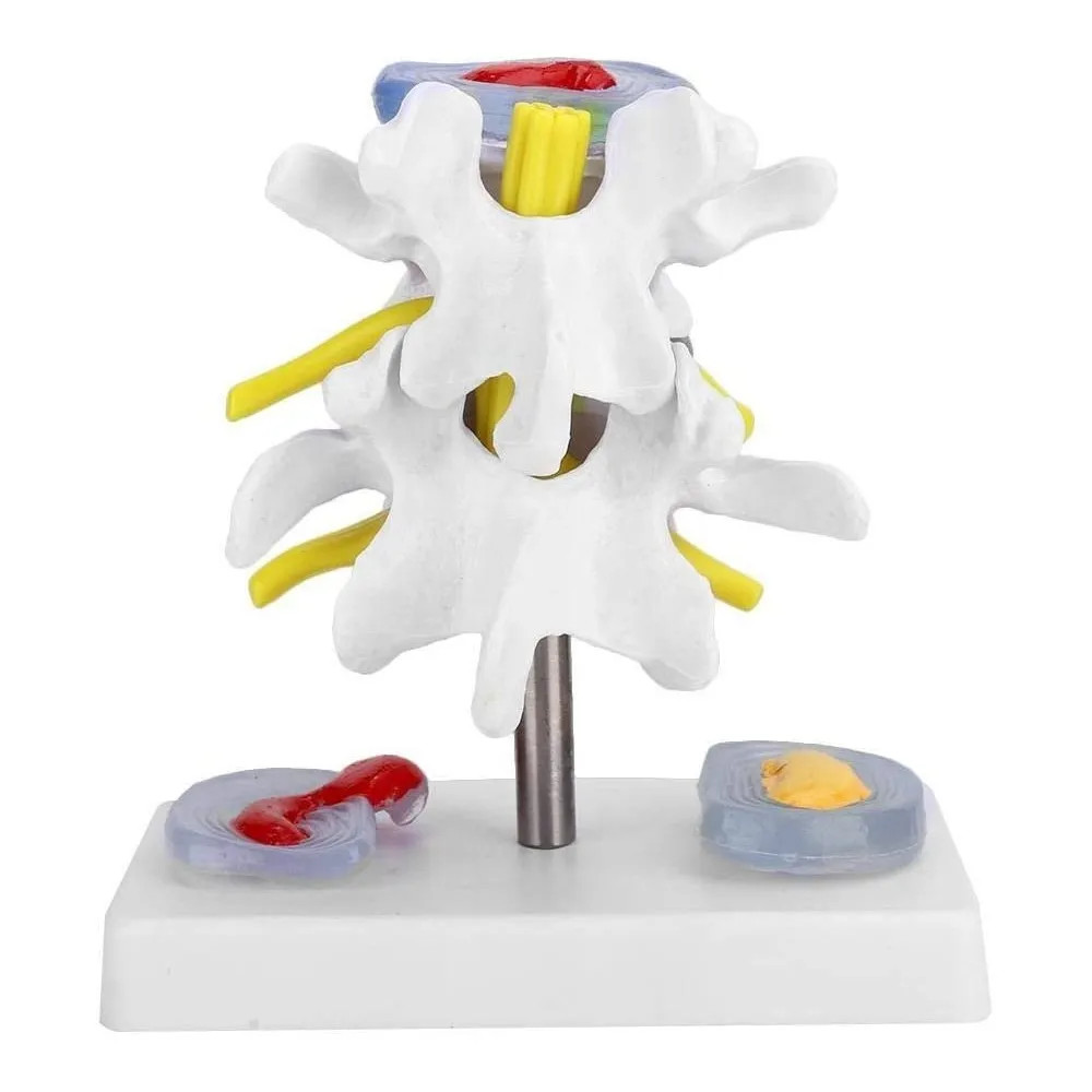 Anatomical Lumbar Disc Herniation Demonstration Model Human Spine
