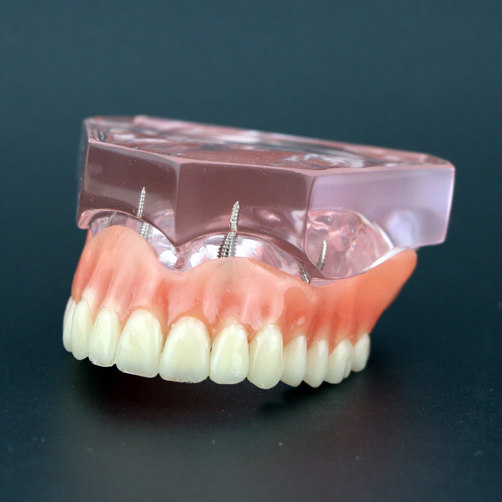 Dental Implants Model Demo Overdenture Typodont Teeth Superior Anatomical model