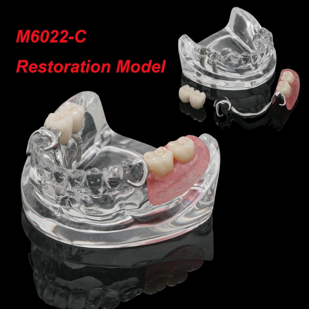 Dental Typodont Model M6022-C w/ Partial Denture 2 Demo& Implants Restoration