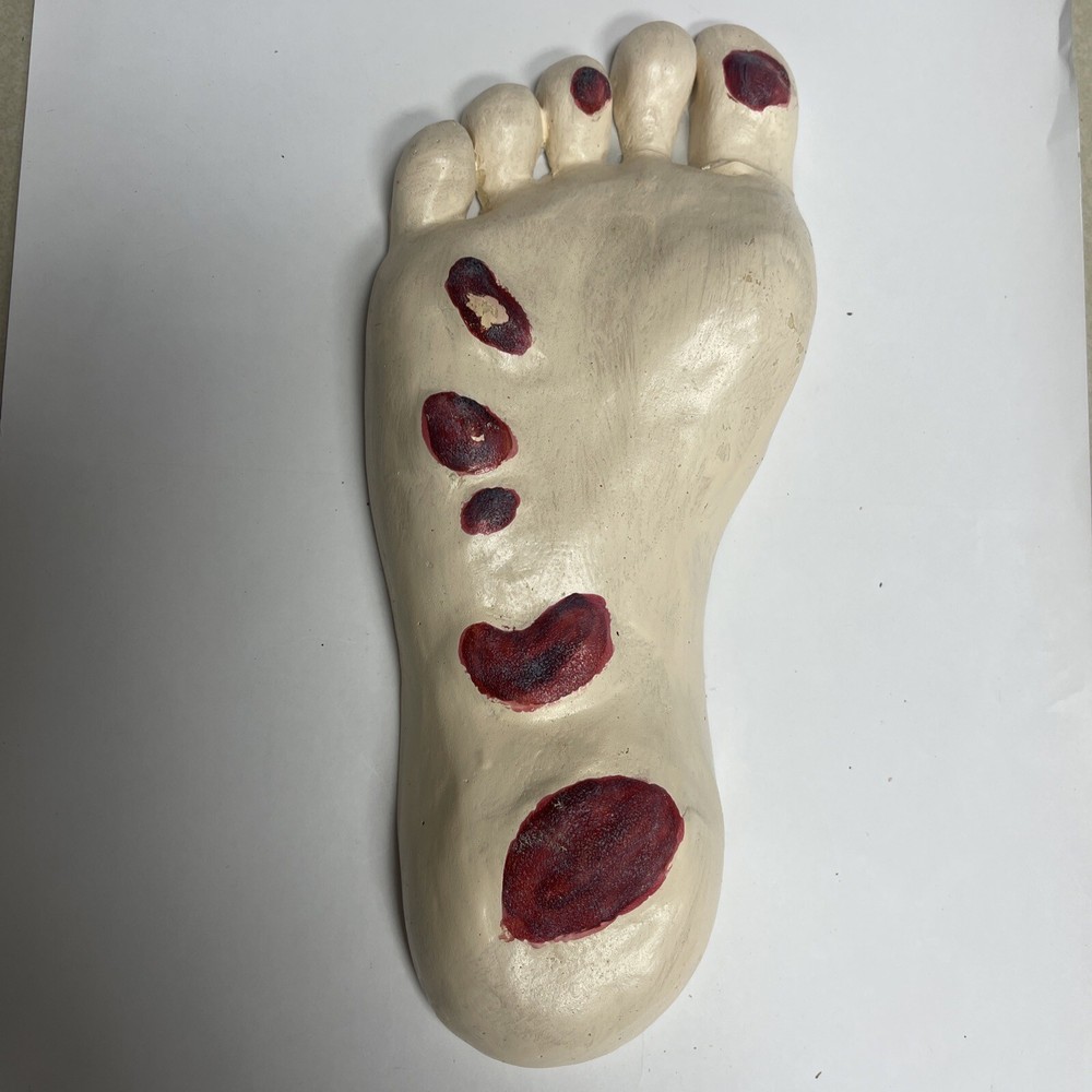 Vintage Foot Kaposi Sarcoma Anatomical Pathology Model