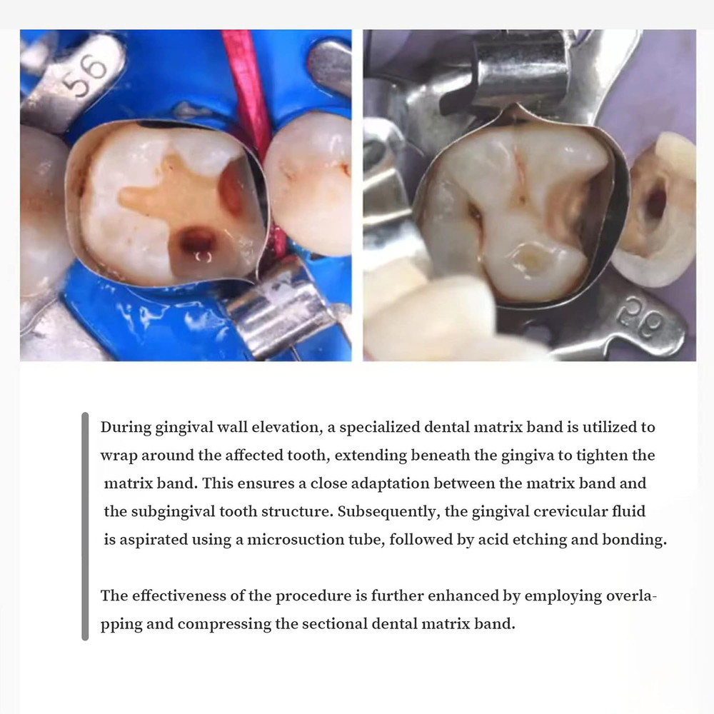 100/ Dental Tofflemire Type Matrix Bands Margin Elevation Gingival Wall Lifting