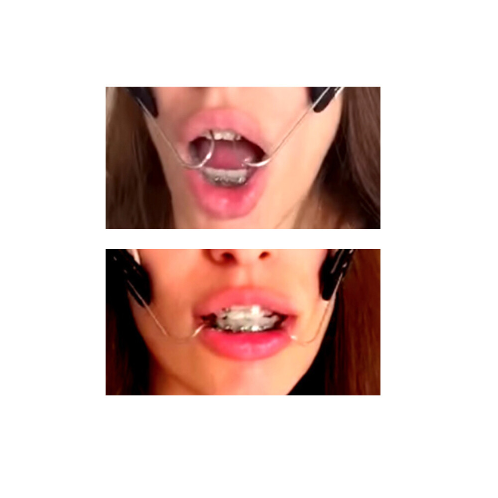 J&J Ortho™ Orthodontic J-Hook Type-B (Pair)