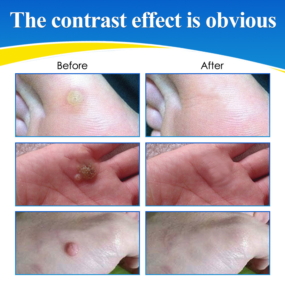 Wart Remover Liquid, Fast Acting to Remove Common and Plantar Warts, Flat Warts
