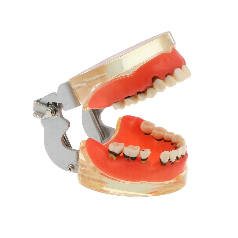 Dental Periodontal Pathological Disease M4017 Removable Teaching Study Model