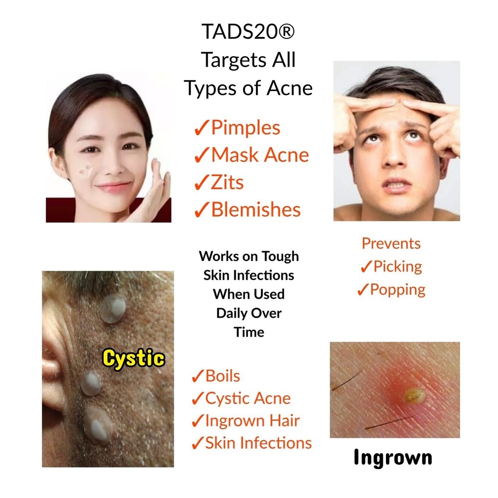 [5pk] [100] Acne Dot Pimple Patches, FACE SPOT DOTS [TEA TREE] Medium Size