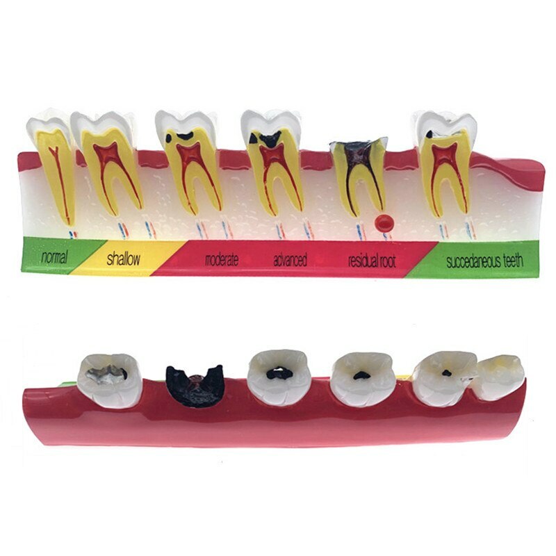 Dental caries classify model of pathological process around Dental caries Model