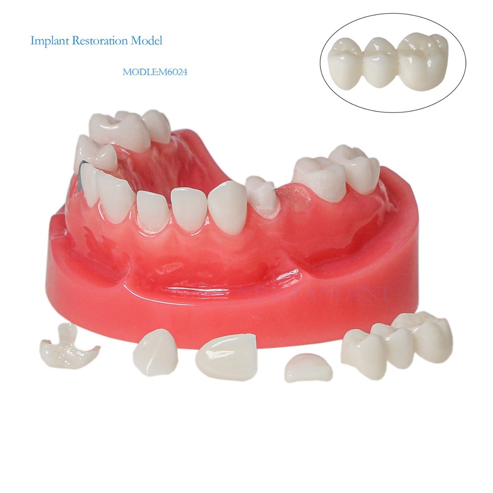Dental Typodont Implant Restoration Overdenture Model Demo Practice Type Model